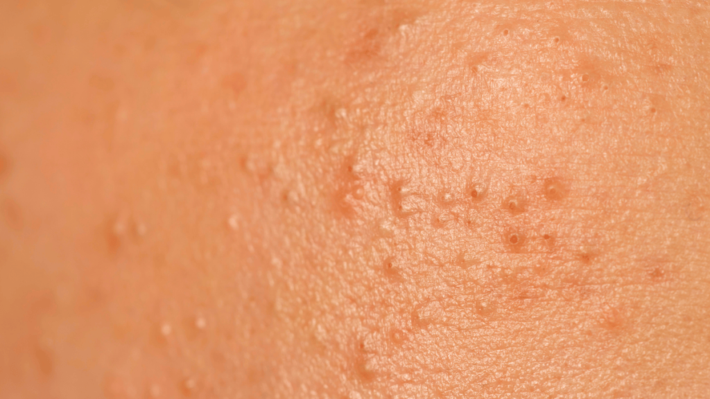 Closed Comedones acne Closed Comedones acne