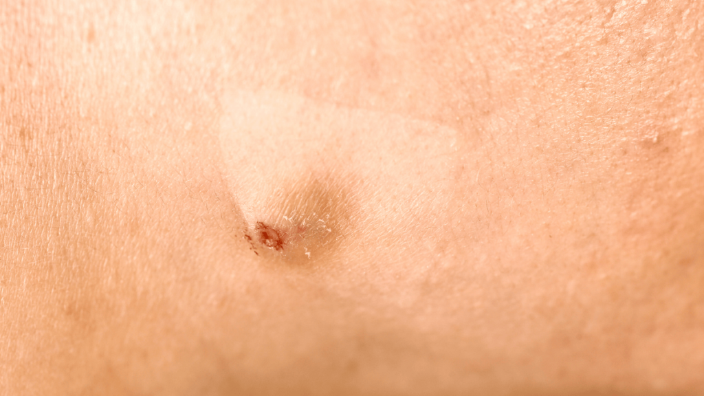 Cystic Acne Cystic Acne