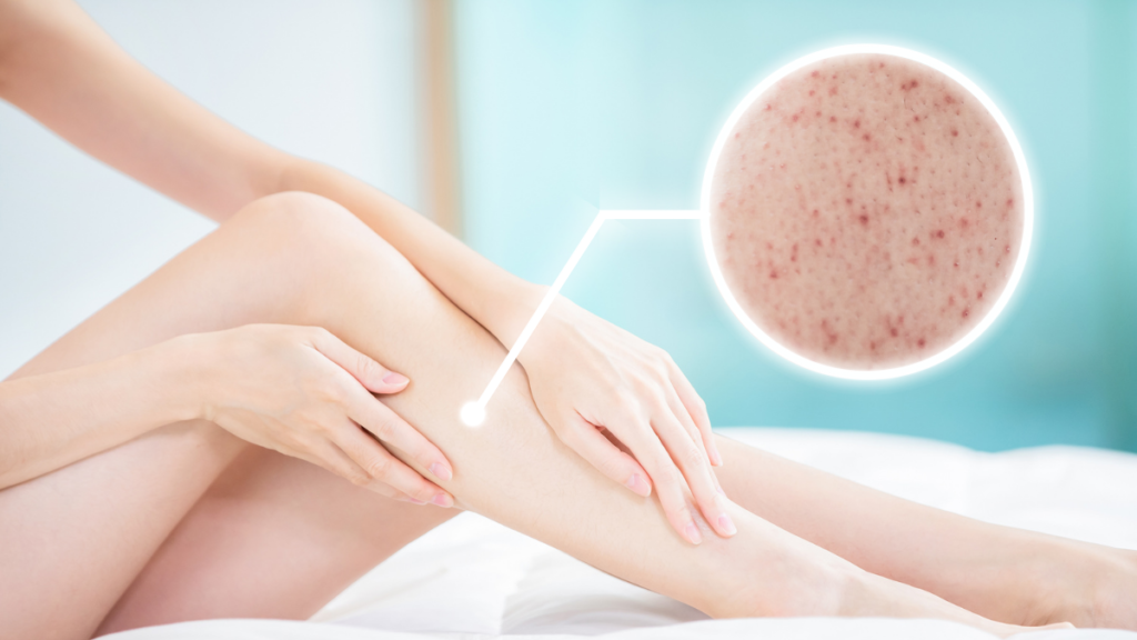 Keratosis Pilaris