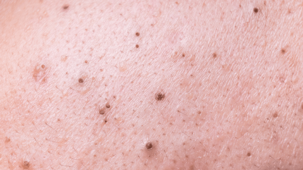 Open Comedones acne Open Comedones acne