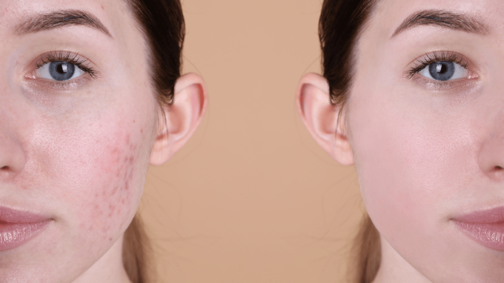 Treat acne Treat acne