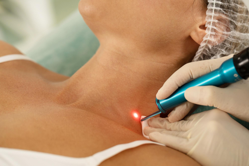 removal-of-pigmentation-or-birthmarks