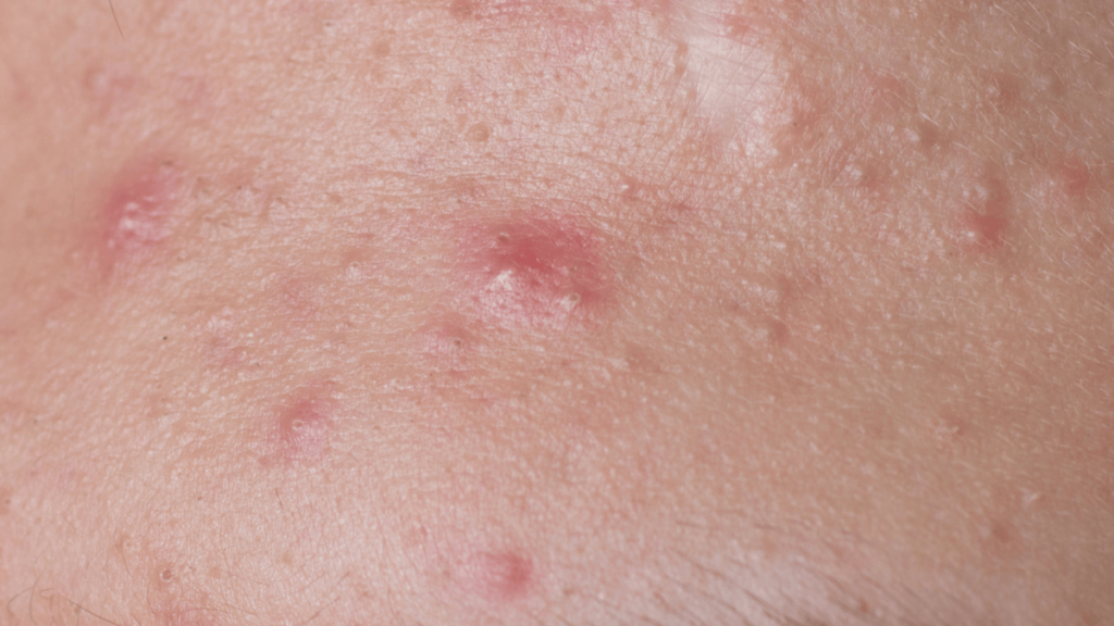 Nodules acne