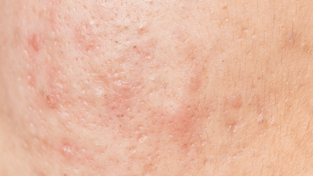 Papules acne