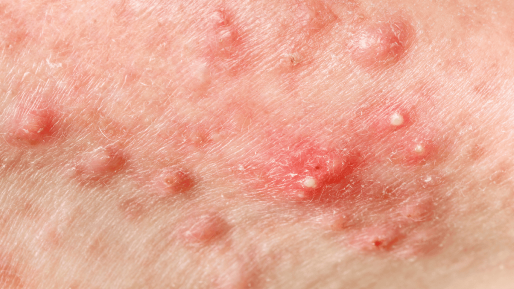 Pustules acne