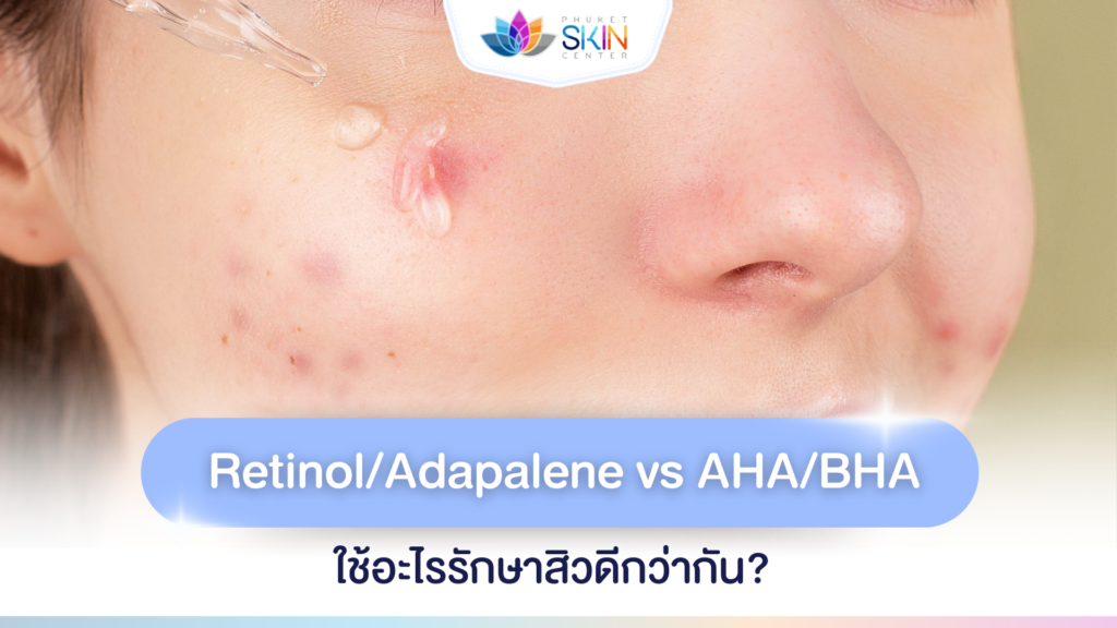 ไขข้อสงสัยชาวเป็นสิว! ใช้ Retinol หรือ Adapalene รักษาสิว vs ใช้กรด AHA ...